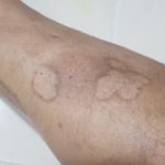 Psoriasis-1-kritasankalp