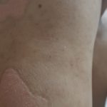 Psoriasis-11-kritasankalp