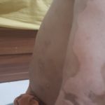 Psoriasis-12-kritasankalp