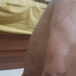 Psoriasis-13-kritasankalp