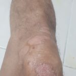 Psoriasis-2-kritasankalp
