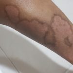 Psoriasis-3-kritasankalp