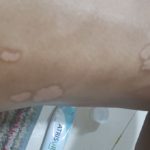 Psoriasis-4-kritasankalp