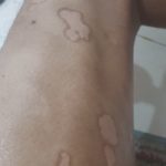 Psoriasis-5-kritasankalp
