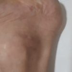 Psoriasis-6-kritasankalp
