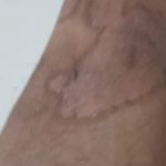 Psoriasis-7-kritasankalp