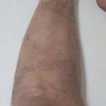 Psoriasis-8-kritasankalp