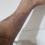 Psoriasis-9-kritasankalp